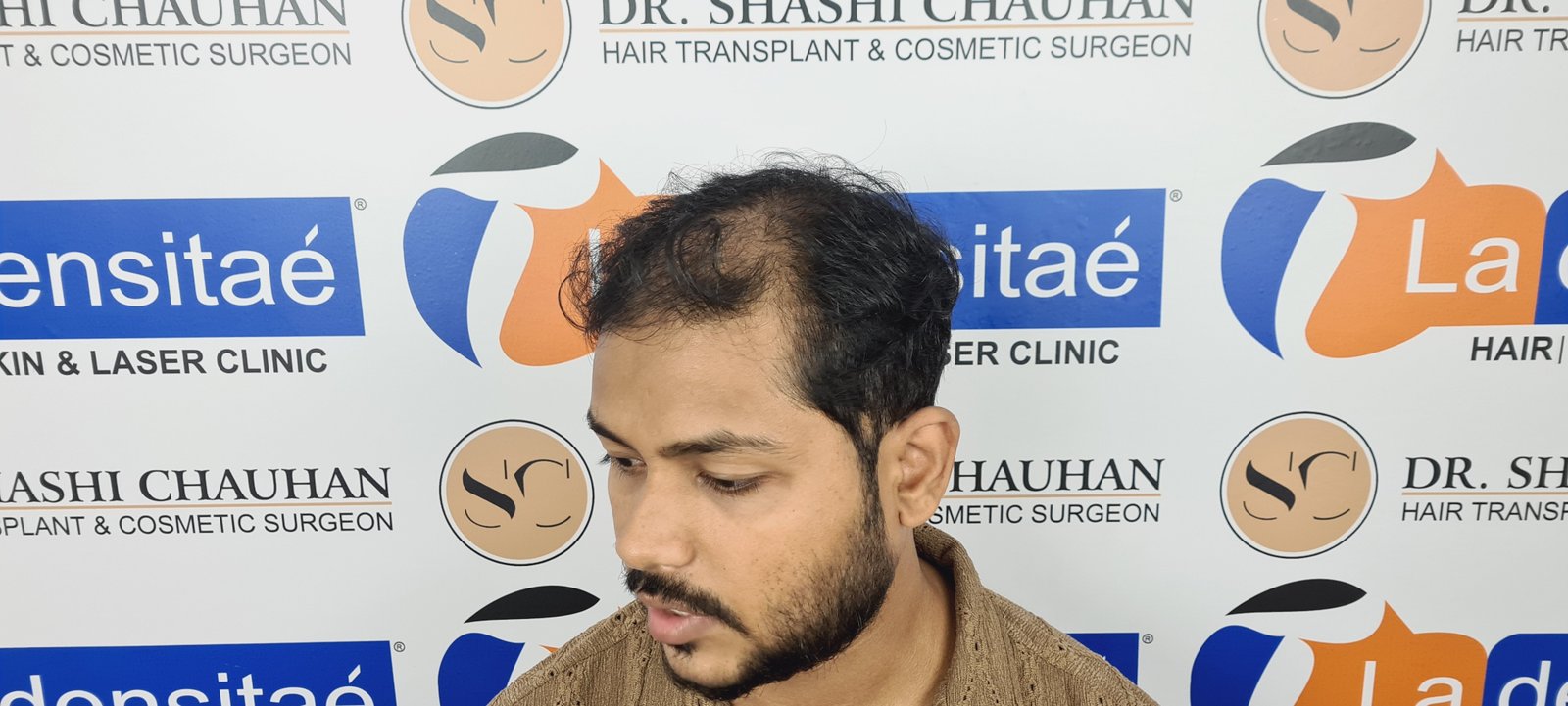 Azher Before Hair Transplant