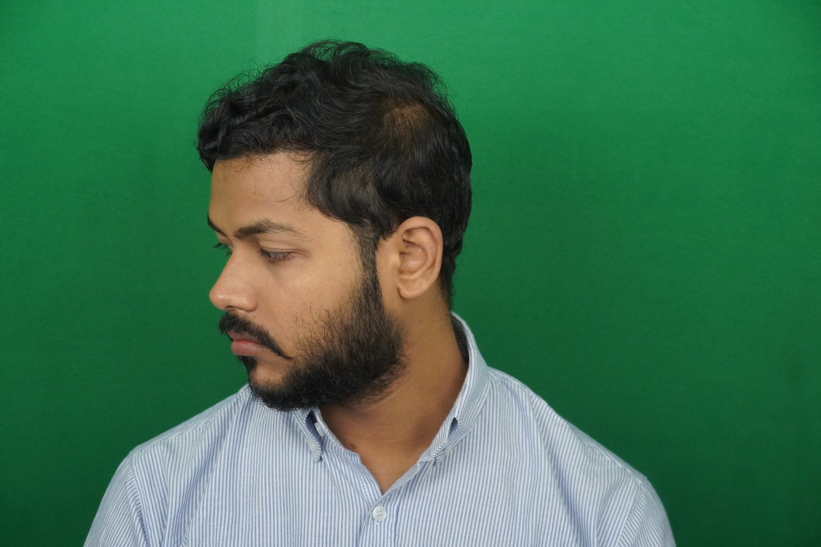 Azher After Hair Transplant