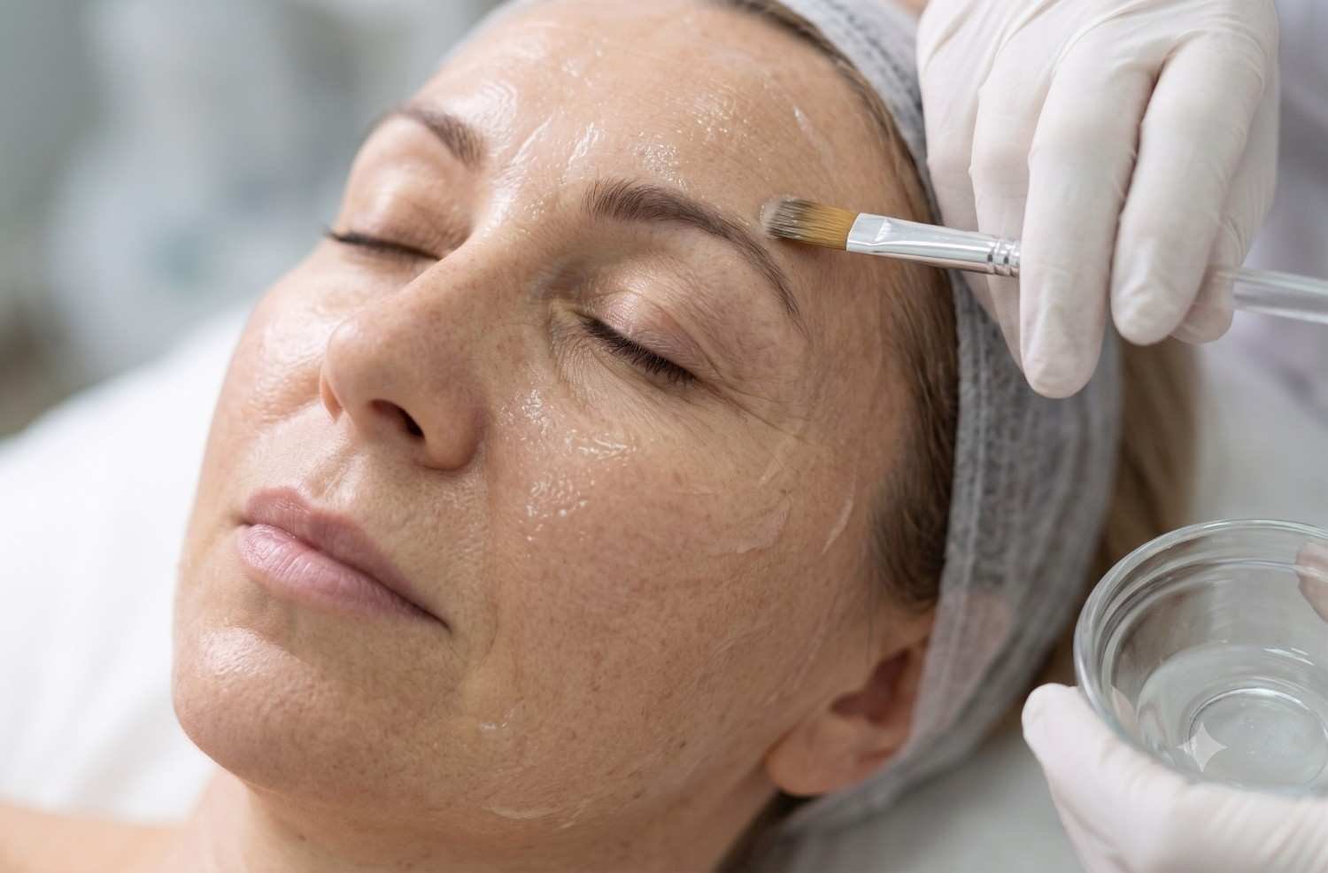 Chemical Peel