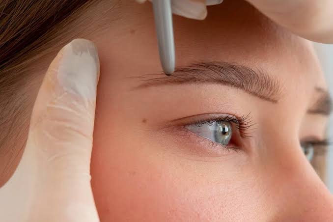 Eyebrow Hair Transplant