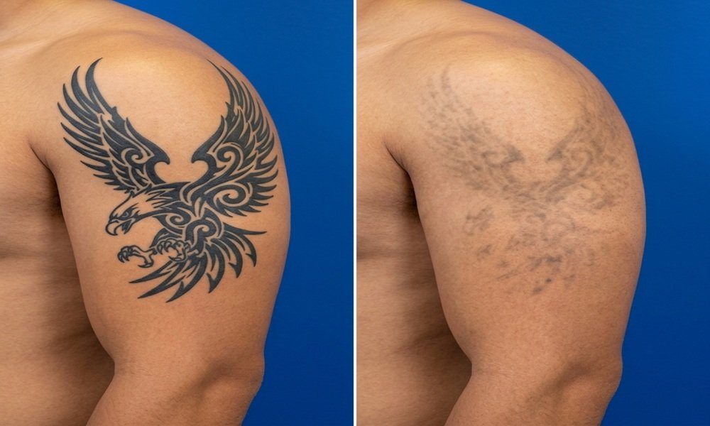 Laser Tattoo Removal Treatment in Lucknow