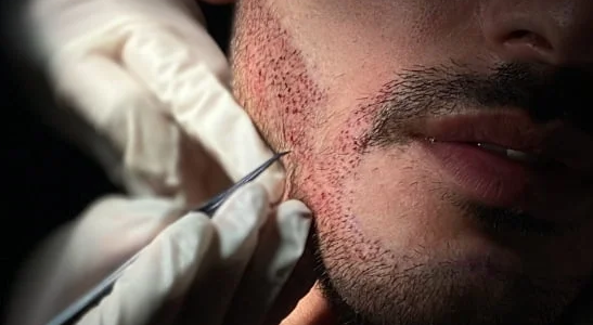 Scalp Preparation