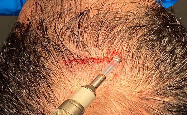 Incisions
