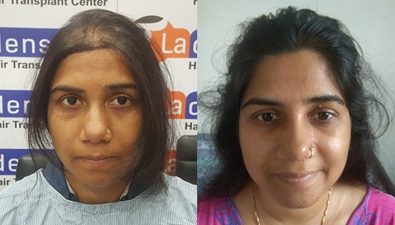 Female Hair Transplant Before After Result