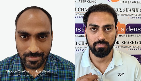 FUE Hair Transplant Before After Result
